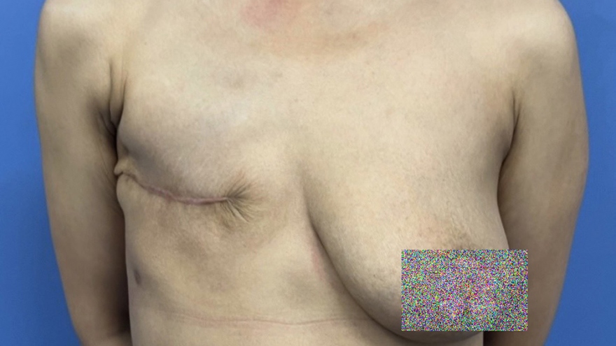 Phẫu thuật tạo hình vú cho bệnh nhân K sau điều trị, không dùng túi silicone